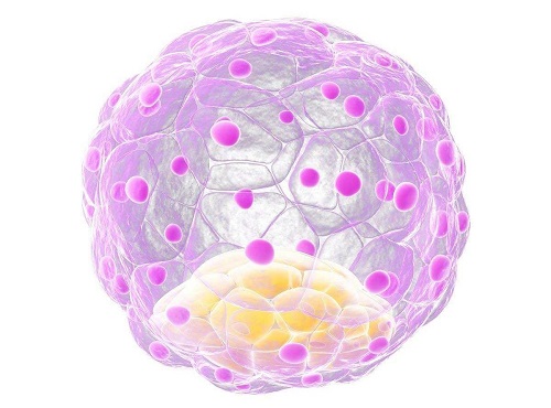 输卵管堵塞有积水能做试管婴儿吗?如何治疗?